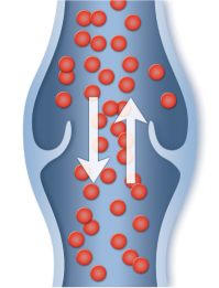 画像:こわれた静脈弁(弁不全)