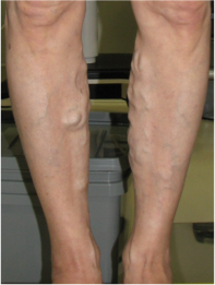 画像:下肢静脈瘤